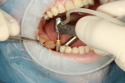 dental implants mclean