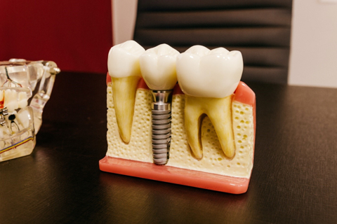 dental implants springfield